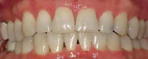 13 After Teeth