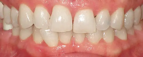 13 Before Teeth