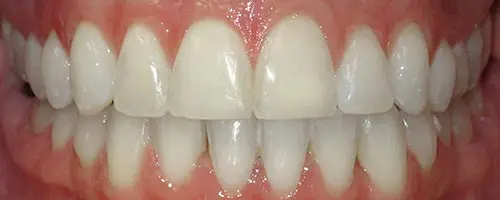 14 After Teeth