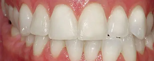 14 Before Teeth
