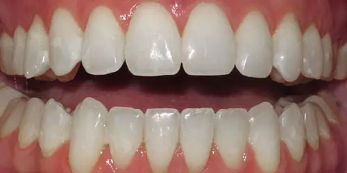 16 After Teeth