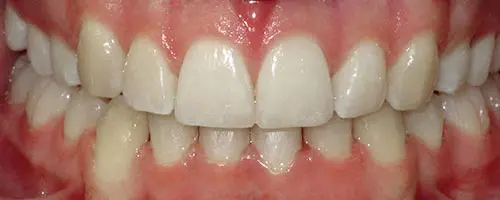 11 After Teeth