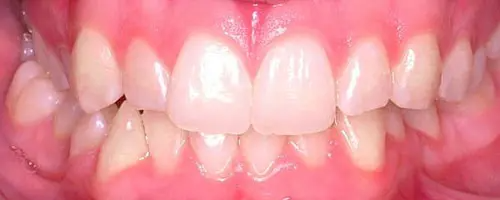 11 Before Teeth
