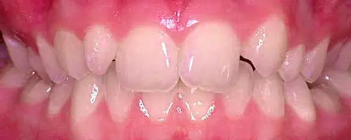 6 Before Teeth