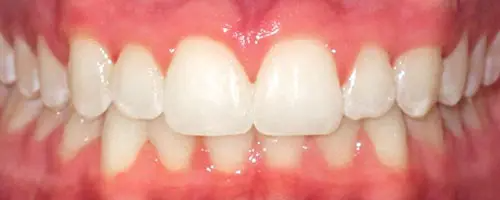 12 After Teeth