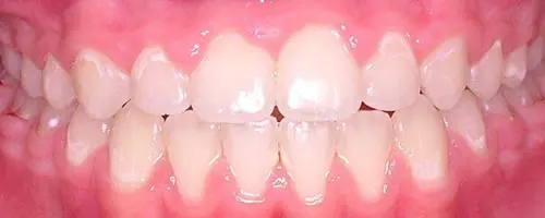 10 After Teeth