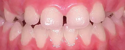 10 Before Teeth