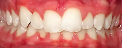 12 Before Teeth