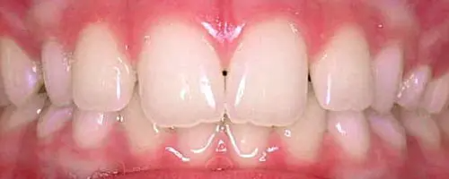 1 Jace Teeth Before