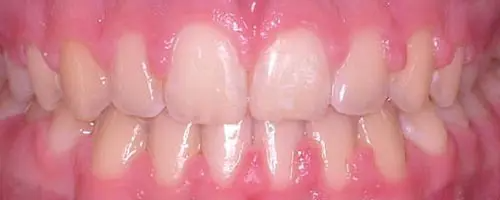 3Bgunn After Teeth