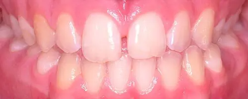 3Bgunn Before Teeth