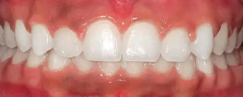 4 After Teeth