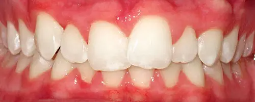 4 Before Teeth