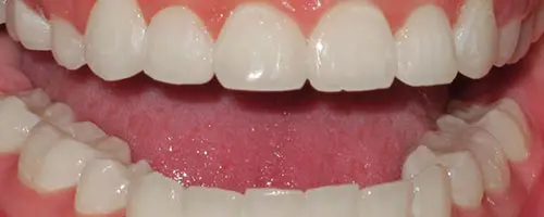 5 After Teeth