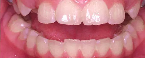 5 Before Teeth