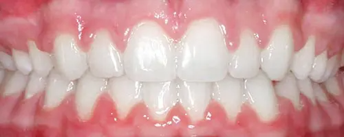 7 After Teeth