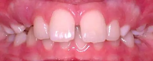 7 Before Teeth