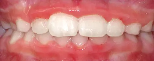 8 After Teeth