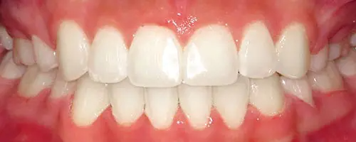 9 After Teeth