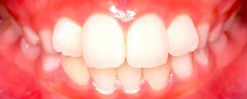 9 Before Teeth